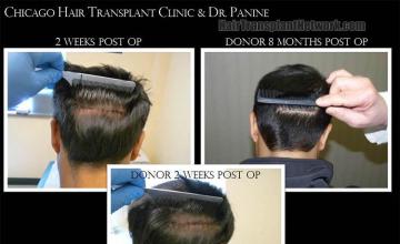 Hair transplantation surgery before and after images