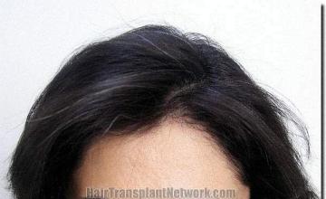 Hair restoration procedure results