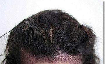 Hair restoration procedure results