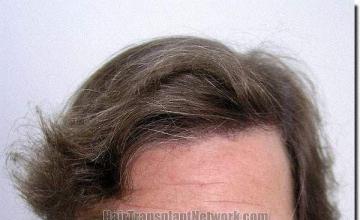 Hair restoration procedure results