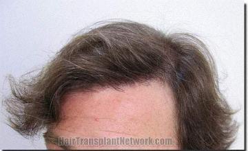 Hair restoration procedure results