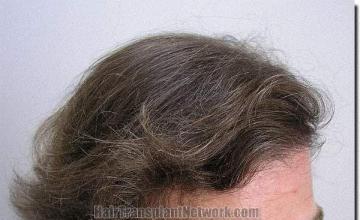 Hair restoration procedure results