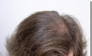 Hair restoration procedure results