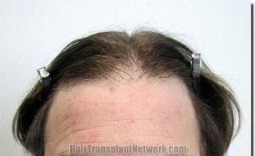 Hair restoration procedure results