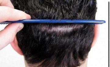 Hair restoration procedure results