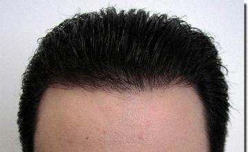 Hair restoration procedure results