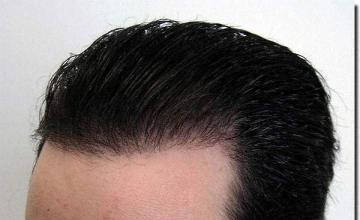 Hair restoration procedure results