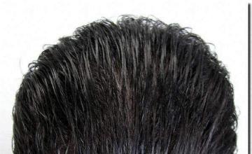 Hair restoration procedure results