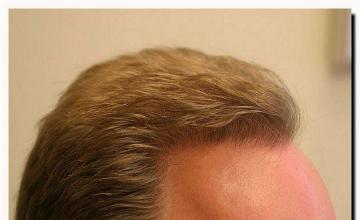 Hair restoration procedure results