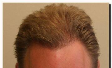 Hair restoration procedure results