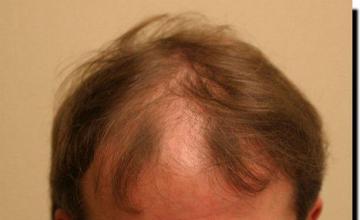 Hair restoration procedure results