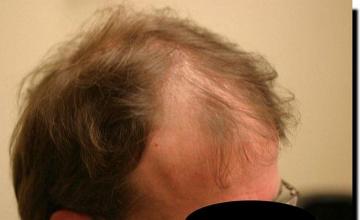 Hair restoration procedure results