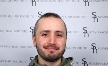 Before hair transplanr