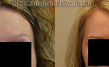 Eyebrow transplant on female patient before and after photos