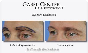 Eyebrow transplantation surgery before and after pictures