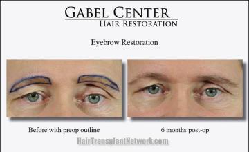 Eyebrow restoration procedure before and after results