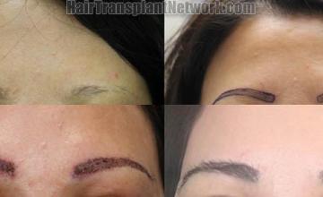 Eyebrow restoration procedure before and after results