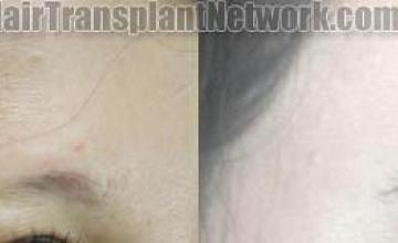 Eyebrow transplantation surgery before and after images