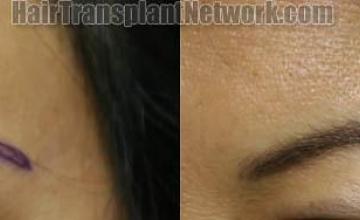 Before and after female eyebrow transplant surgery