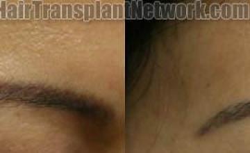 Female eyebrow transplant patient before and after