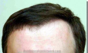 Hair restoration procedure results