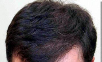 Hair restoration procedure results