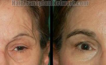 Eyebrow transplantation surgery before and after 