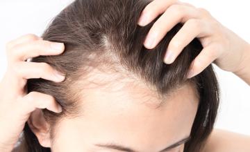 Female Hair Loss - Treatment and Restoration