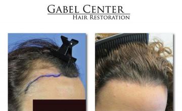 Hair restoration procedure before and after pictures