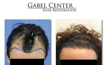 Hair restoration surgery before and after images