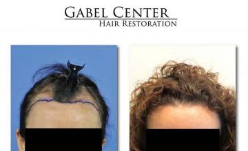 Hair restoration procedure before and after results