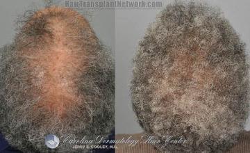 Female hair replacement surgery before and after images