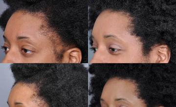 Hair restoration procedure before and after results