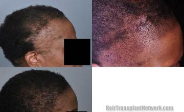 Hair transplantation surgery before and after images