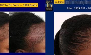 Hair restoration procedure before and after results