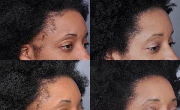 Before and after hair transplant procedure images