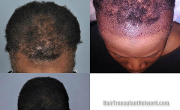 Hair transplantation surgery before and after photos