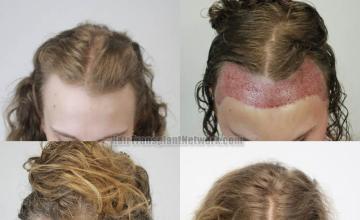 Female hair transplantation surgery before and after images