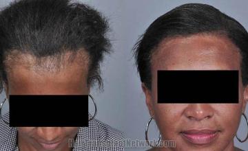 Hair restoration procedure before and after results