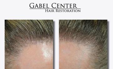 Hair transplantation surgery before and after pictures