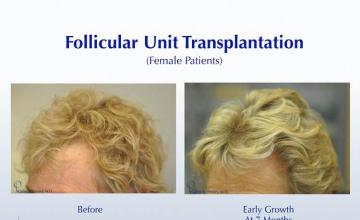 Hair transplantation surgery before and after images