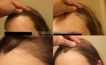 Hair transplantation surgery before and after photos