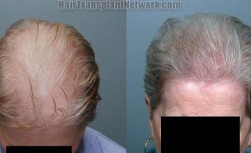 Top view before and after female hair restoration images