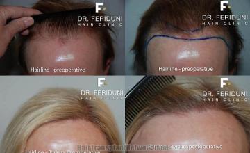 Hair restoration procedure before and after pictures