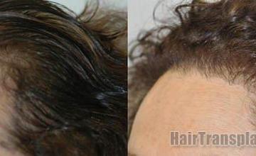 Right view - female hair transplant procedure pictures