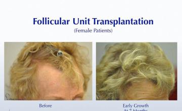 Hair transplantation surgery before and after pictures