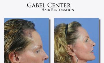 Hair restoration procedure before and after pictures