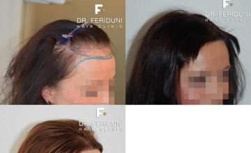 Hair restoration procedure before and after pictures