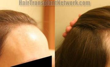 Female hair transplantation surgery before and after photos