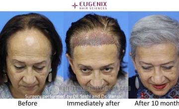 Female hair transplantation surgery before and after images